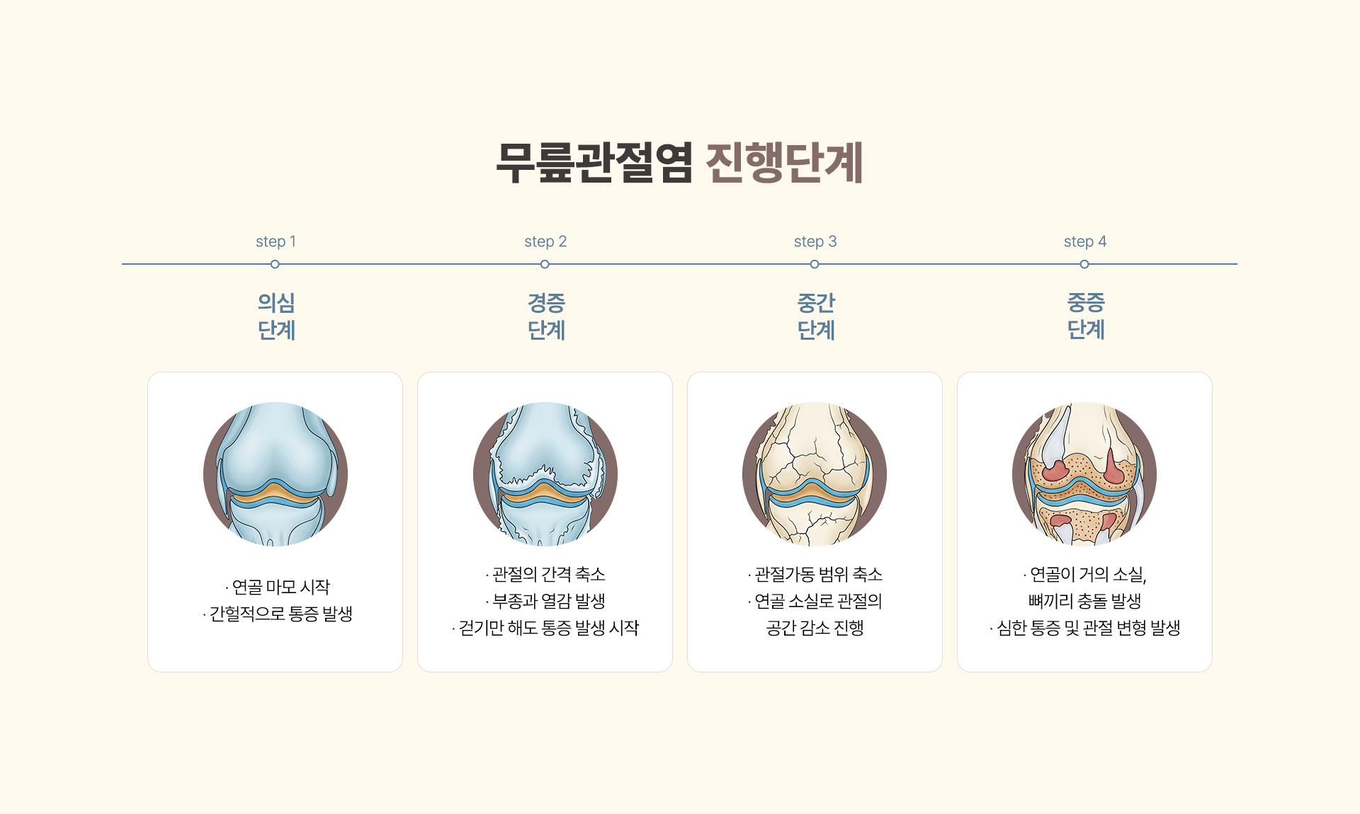 무릎관절염 진행단계, 의심단계, 경증단계, 중간단계, 중증단계